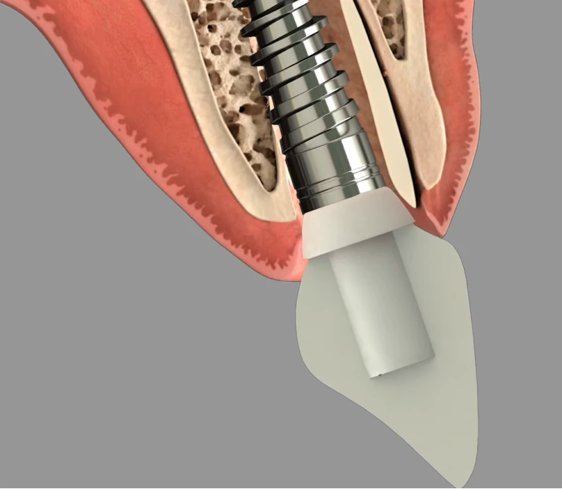 Open Reduction Internal Fixation of Mandibular Fracture