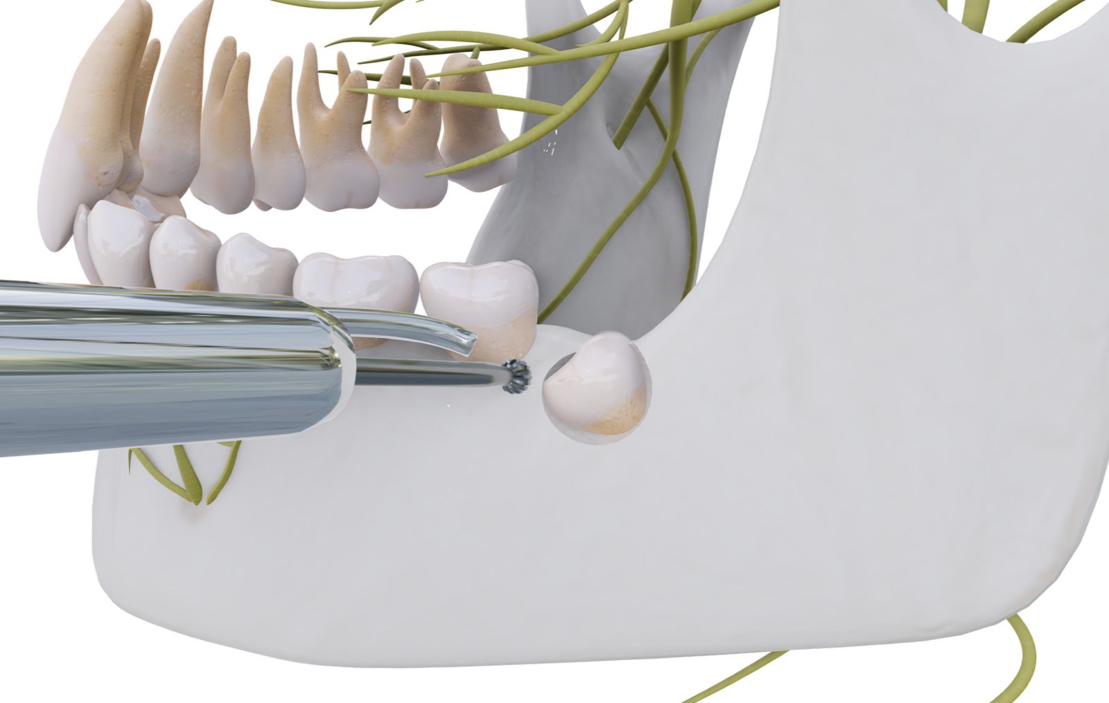 Extracción Quirúrgica de canino incluido en posición 13. Manejo de Fibrina-CGF