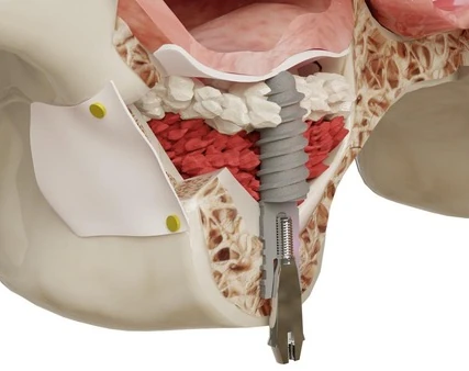 Elevación de Seno Maxilar y reconstrucción del proceso alveolar. 3 de 3