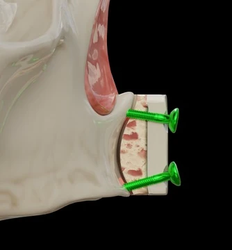 Exodoncia quirúrgica de cordal incluido en mandíbula y colocación de implantes en 25i, 26i y 27i. 2 de 2