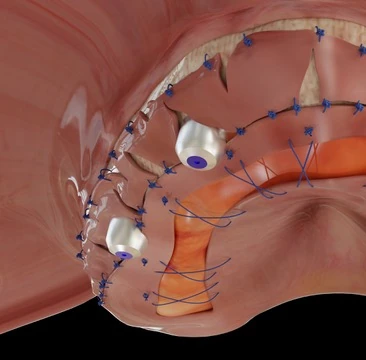 Arthrocentesis and Lavage for TMJ Internal Derangement