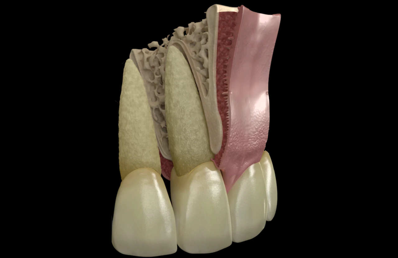 Gingivectomia y gingivoplastia con laser. Dr Joaquín García Rodriguez