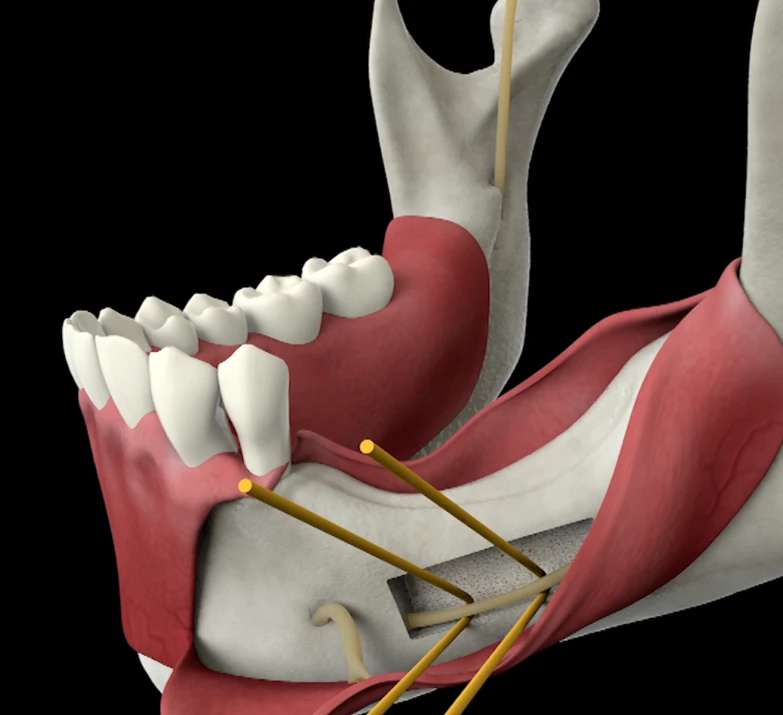 Transposición de nervio en paciente 233