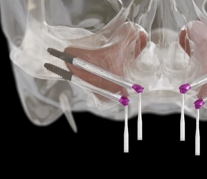 Zygomatic Arch Fracture Reduction and Fixation